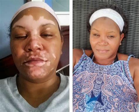 vitiligo organics|vitiligo organics before and after.